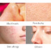 Balances oil secretion, absorbs pore dirt, tightens large pores, and controls oil.